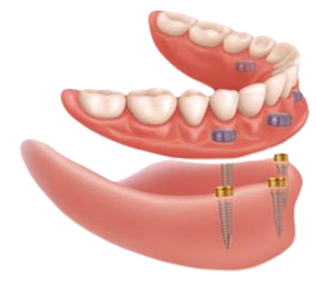Implant Dentures