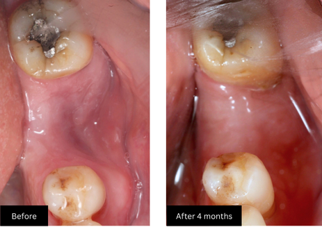 Bone graft 2