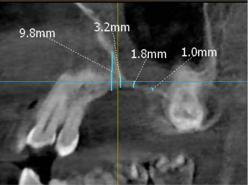 Closed Sinus Lift
