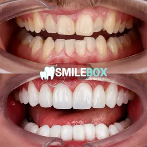 Ceramic veneer