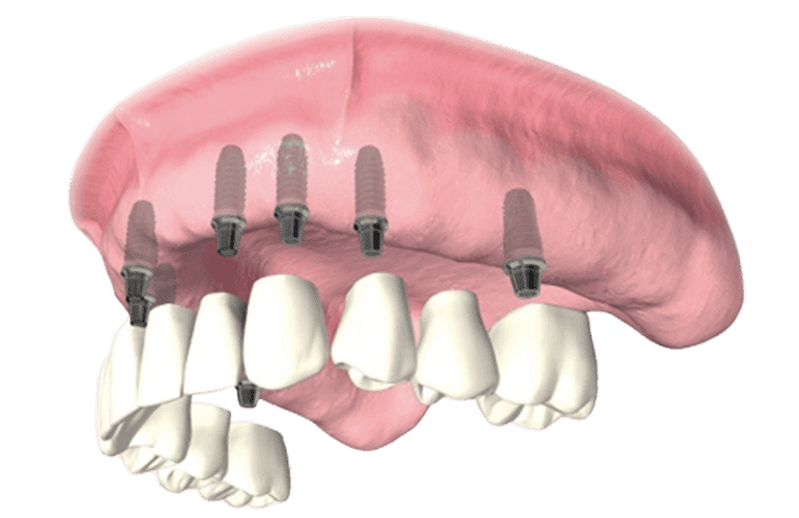 Dental Implant Bridges