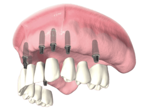 Dental Implant Bridges